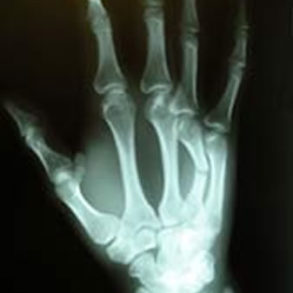 Hand - X-Ray