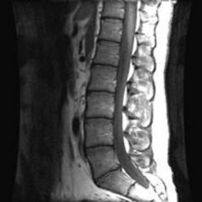 MRI - Spine