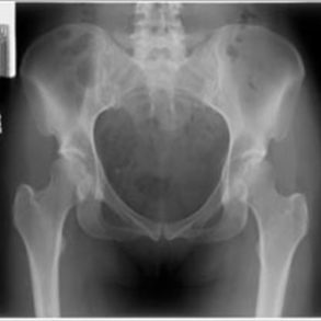 Pelvis - X-Ray